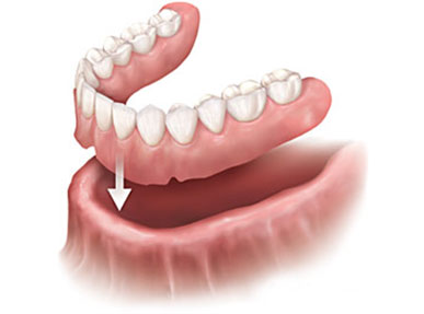 Visual of Dentures