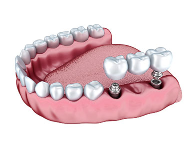 multiple dental implants