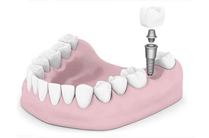 Dental Implant Visual